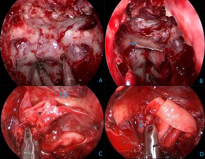 Endoscopic Endonasal Transsphenoidal Surgery for Recurrent Craniopharyngiomas